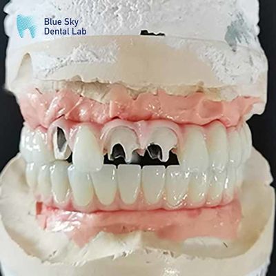 Mua Titanium Malo Bridge Implant Bridge Không có nhiều đơn vị Abutment Cementable online manufacture