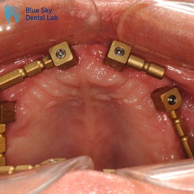 Mua Vàng Titanium đa đơn vị Scan Body CAM System Dentium Scan Body online manufacture