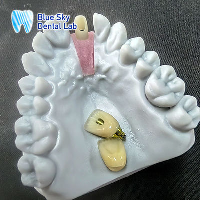 Mua Chiếc đệm Zirconia được nghiền chính xác với vương miện cấy ghép đơn online manufacture