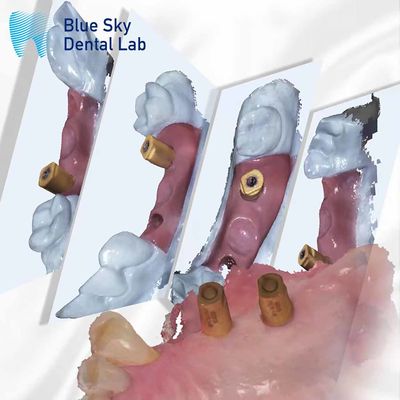 Mua Quét cơ thể tất cả trong một viên nang chữa bệnh răng Blue Sky hệ thống cấy ghép online manufacture