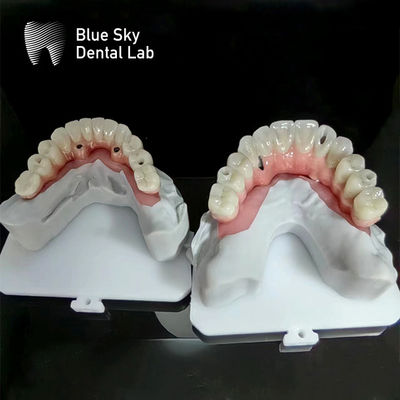 Mua Cấy ghép Sky Blue Full Arch Cấy ghép trường hợp thiên nhiên Cấy ghép trường hợp online manufacture