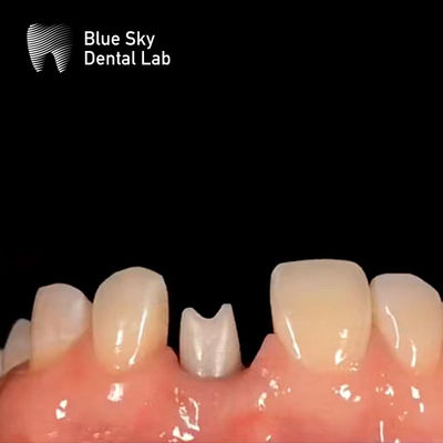 Mua Ống cấy răng hypoallergenic Zirconia Abutment Biocompatible online manufacture