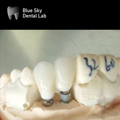 Mua Vương miện đơn Zirconia Abutment Hypoallergenic Implant nha khoa Zirconia Abutment online manufacture