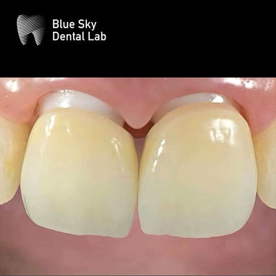 Mua Lớp cấy ghép Zirconia Crown Zirconia Abutment Biocompatible online manufacture