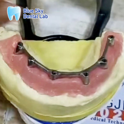 Mua Titanium Bar Overdenture Cấy ghép tháo rời với Overdenture online manufacture