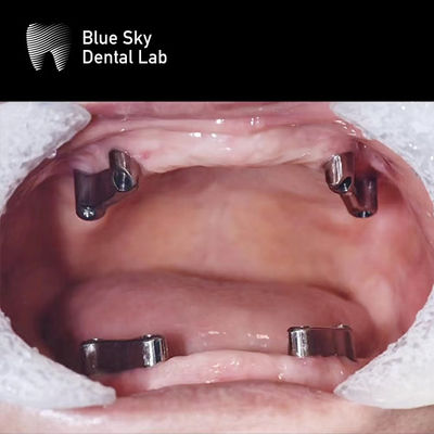 Mua Nhựa răng nha khoa Titanium thanh loại bỏ Blue Sky hệ thống cấy ghép online manufacture