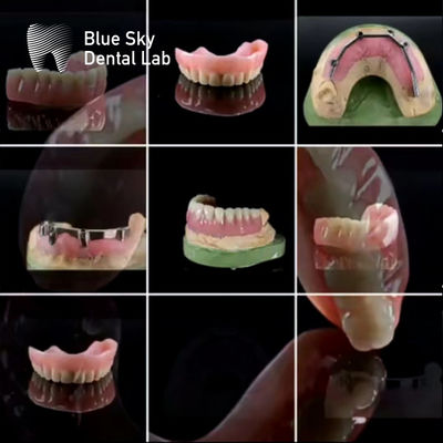 Mua Đường răng Titanium được tùy chỉnh với răng giả Acrylic online manufacture