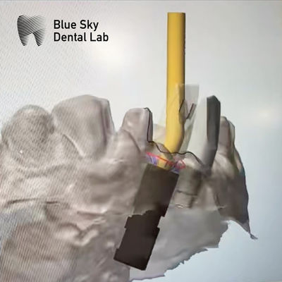Mua Ti cơ sở vít giữ Abutment cấy ghép góc vít kênh abutment online manufacture