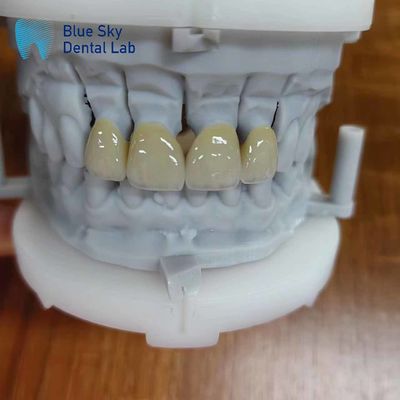 Zirconia bền được lớp phủ bằng sứ Zirconia nhiều lớp vương miện