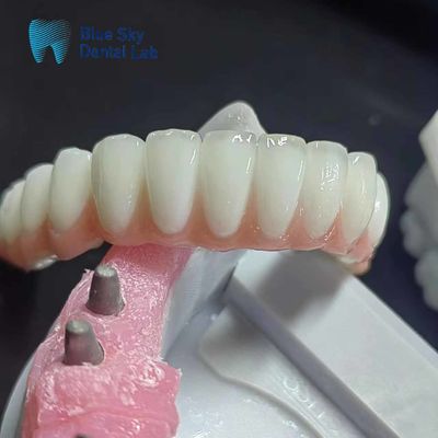 Vỏ cấy ghép Zirconia thông thường Vỏ cấy ghép răng cá nhân