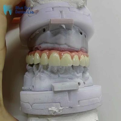 Nature vỏ cấy ghép răng nhân tạo tùy chỉnh vỏ cấy ghép miệng đầy đủ