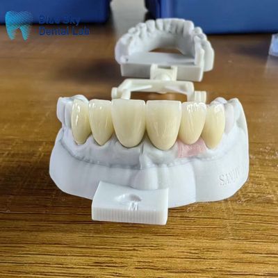 Vương miện Zirconia lớp cao trong suốt với vương miện cấy ghép
