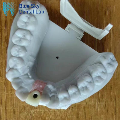Khử trùng bằng hơi nước Vương miện cấy ghép đơn bề mặt mịn Vương miện cấy ghép răng