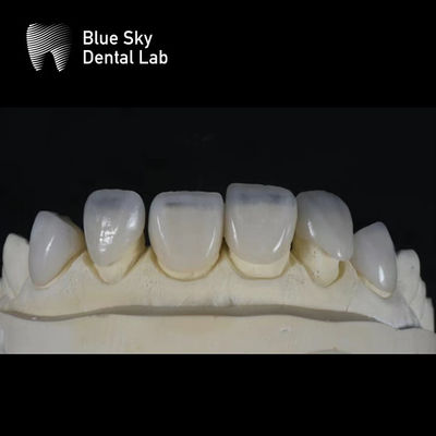 Ultra Thin Sleek Veneer Cases 0.3mm Thinest Custom Veneers (Các vỏ veneer tùy chỉnh mỏng nhất