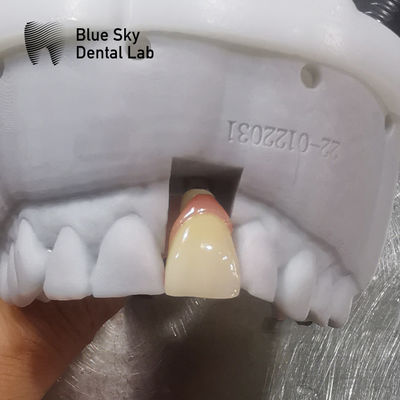 Vỏ cấy ghép thông thường Khả năng tương thích chung Vỏ cấy ghép nha khoa