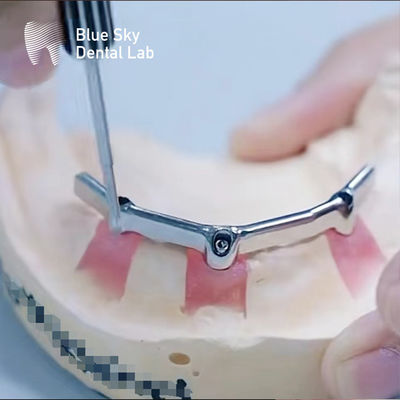 Đường răng Titanium chính xác với phụ kiện quý giá tương thích sinh học