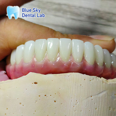 Khả năng tương thích phổ quát Ống cấy ghép tùy chỉnh Ống cấy ghép toàn miệng