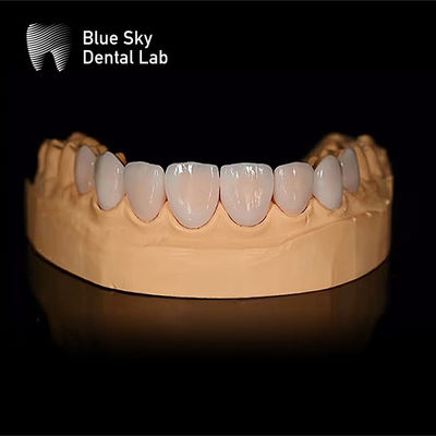Vỏ veneer nha khoa hình chữ nhật nhẹ với cài đặt thụ động Chỉ 0,3mm