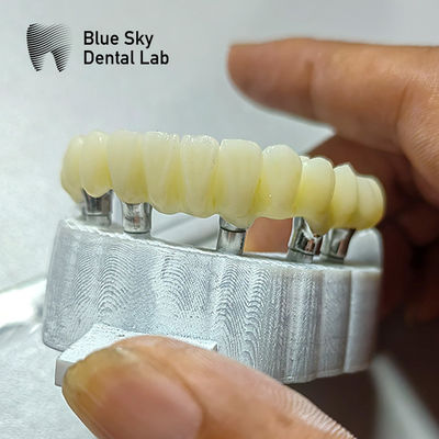 Các trường hợp cấy ghép cầu PMMA cho các kịch bản cấy ghép bề mặt mịn