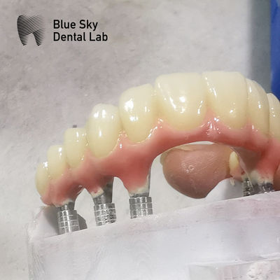Nature Shape Full Arch Implant Case Bề mặt mịn