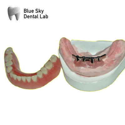 Đường răng Titanium có thể tháo rời cho răng giả Blue Sky