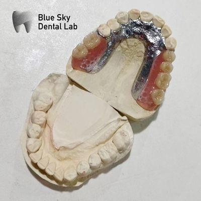 Định chỉnh răng giả khung kim loại răng nhựa Rpd khung kim loại