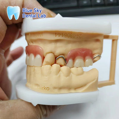 Phục hồi nụ cười răng giả Acrylic một phần với kẹp