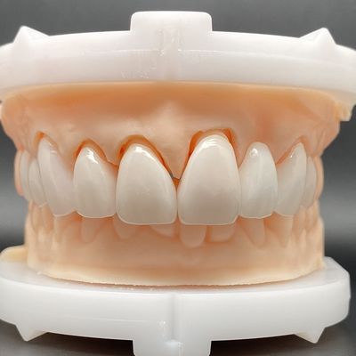 EMax Veneer Cases Passive Fitting In Multiple Colors MAKE Beautiful Smile With Minimal Tooth Preparation (Thiết kế răng tối thiểu để tạo nụ cười đẹp)