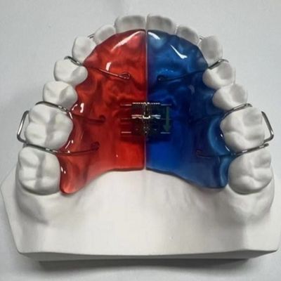 Thép không gỉ Acrylic Screw Expanders Điều trị chỉnh nha có thể tháo